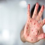 ایران در مرحله حذف سرخک و سرخجه / واکسیناسیون موثرترین راه کنترل بیماری‌های واگیر